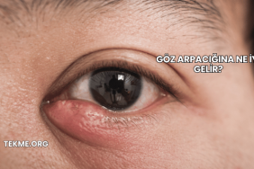 Göz Arpacığına Ne İyi Gelir?