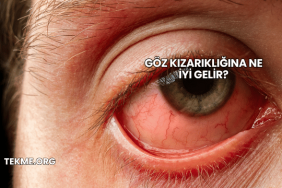 Göz Kızarıklığına Ne İyi Gelir?