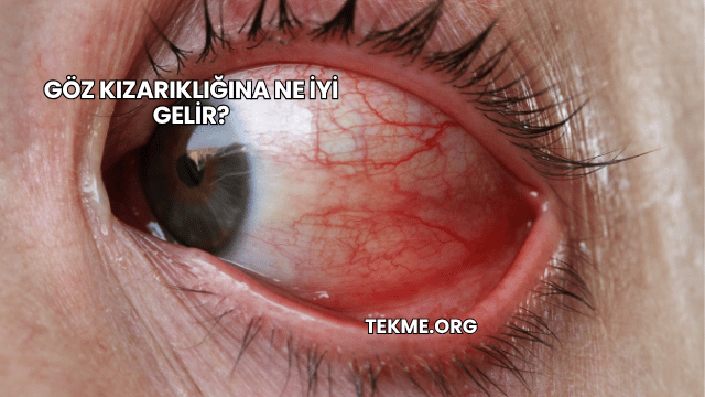 Göz Kızarıklığına Ne İyi Gelir?