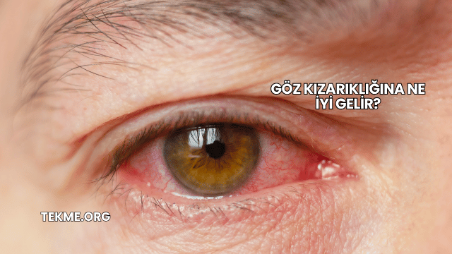 Göz Kızarıklığına Ne İyi Gelir?