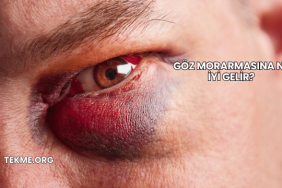 Göz Morarmasına Ne İyi Gelir?