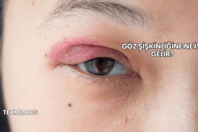 Göz Şişkinliğine Ne İyi Gelir?