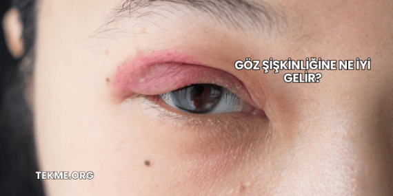 Göz Şişkinliğine Ne İyi Gelir?