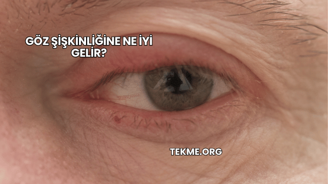 Göz Şişkinliğine Ne İyi Gelir?