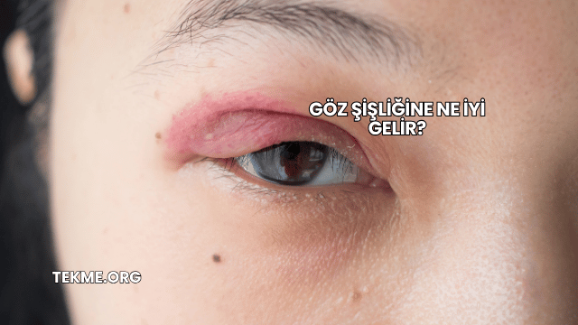 Göz Şişliğine Ne İyi Gelir?
