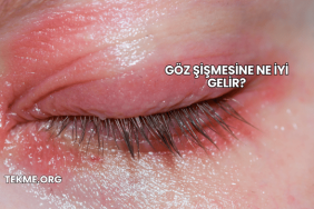 Göz Şişmesine Ne İyi Gelir?