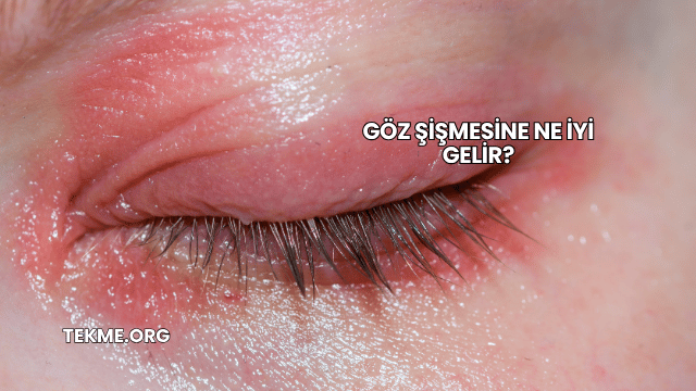Göz Şişmesine Ne İyi Gelir?