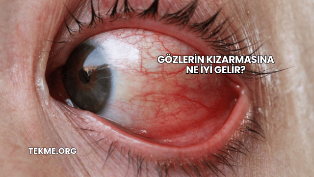 Gözlerin Kızarmasına Ne İyi Gelir?