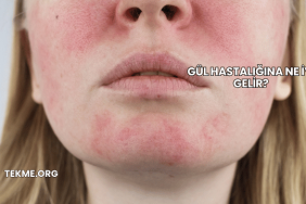 Gül Hastalığına Ne İyi Gelir?