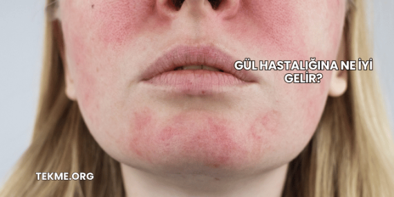 Gül Hastalığına Ne İyi Gelir?