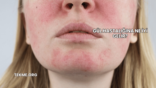 Gül Hastalığına Ne İyi Gelir?