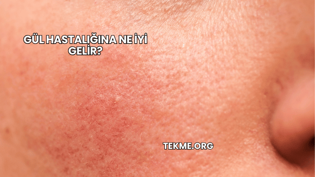 Gül Hastalığına Ne İyi Gelir?