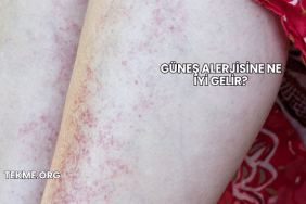 Güneş Alerjisine Ne İyi Gelir?