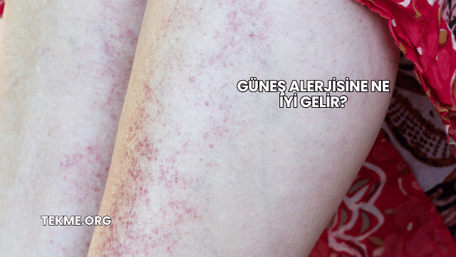 Güneş Alerjisine Ne İyi Gelir?