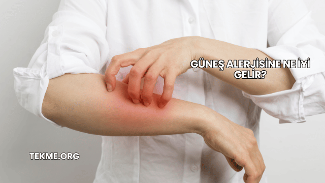 Güneş Alerjisine Ne İyi Gelir?