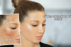 Güneş Lekelerine Ne İyi Gelir?
