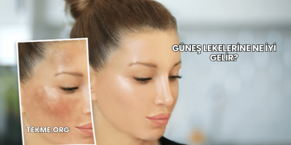 Güneş Lekelerine Ne İyi Gelir?