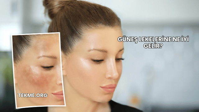 Güneş Lekelerine Ne İyi Gelir?