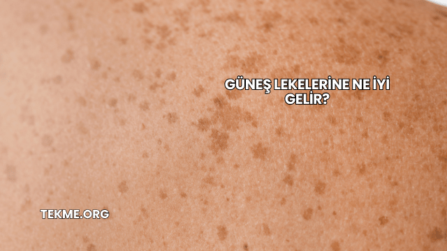 Güneş Lekelerine Ne İyi Gelir?