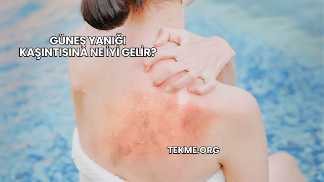 Güneş Yanığı Kaşıntısına Ne İyi Gelir?