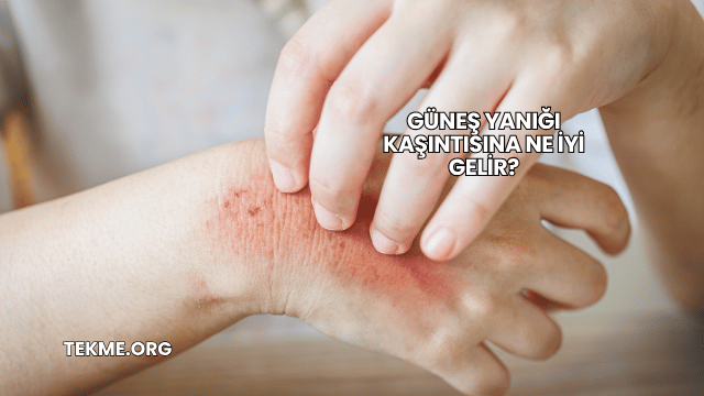 Güneş Yanığı Kaşıntısına Ne İyi Gelir?