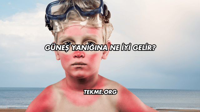 Güneş Yanığına Ne İyi Gelir?