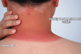 Güneş Yanmasına Ne İyi Gelir?