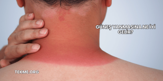 Güneş Yanmasına Ne İyi Gelir?