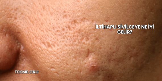 İltihaplı Sivilceye Ne İyi Gelir?