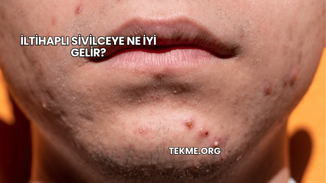 İltihaplı Sivilceye Ne İyi Gelir?