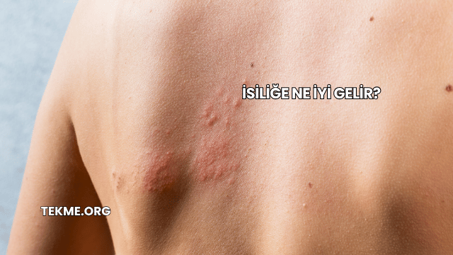 İsiliğe Ne İyi Gelir?