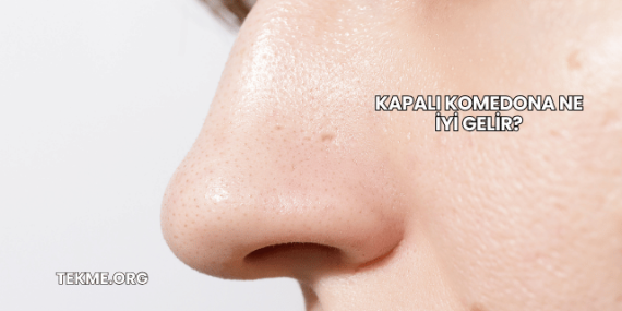 Kapalı Komedona Ne İyi Gelir?