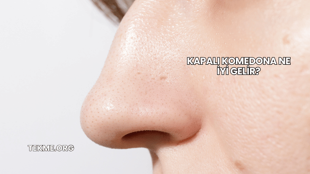 Kapalı Komedona Ne İyi Gelir?
