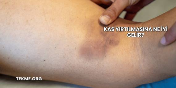 Kas Yırtılmasına Ne İyi Gelir?