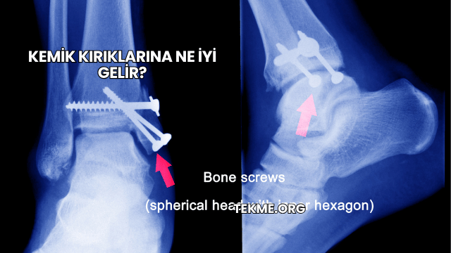 Kemik Kırıklarına Ne İyi Gelir?