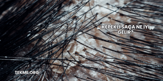 Kepekli Saça Ne İyi Gelir?