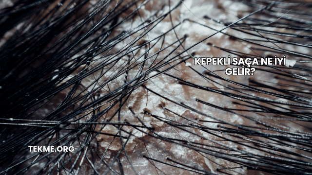 Kepekli Saça Ne İyi Gelir?