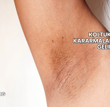 Koltuk Altı Kararmalarına Ne İyi Gelir?