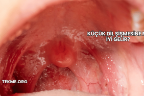 Küçük Dil Şişmesine Ne İyi Gelir?