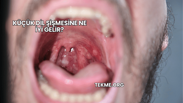 Küçük Dil Şişmesine Ne İyi Gelir?