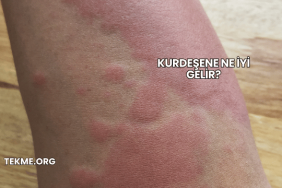 Kurdeşene Ne İyi Gelir?