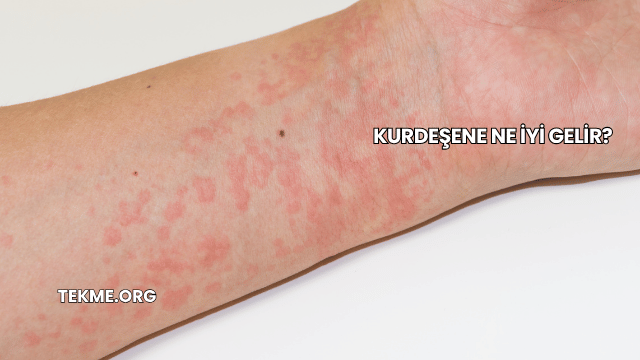 Kurdeşene Ne İyi Gelir?