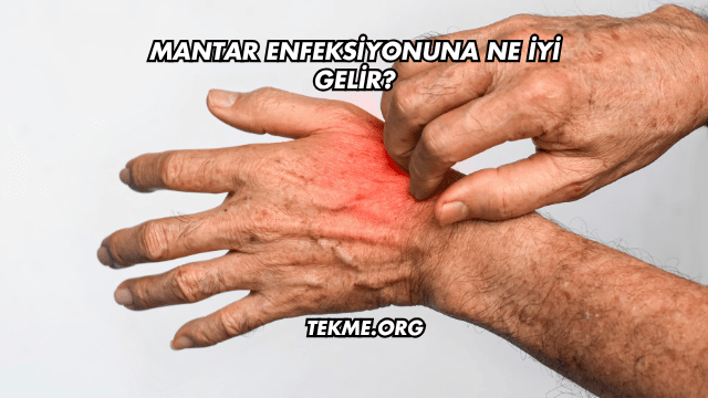 Mantar Enfeksiyonuna Ne İyi Gelir?
