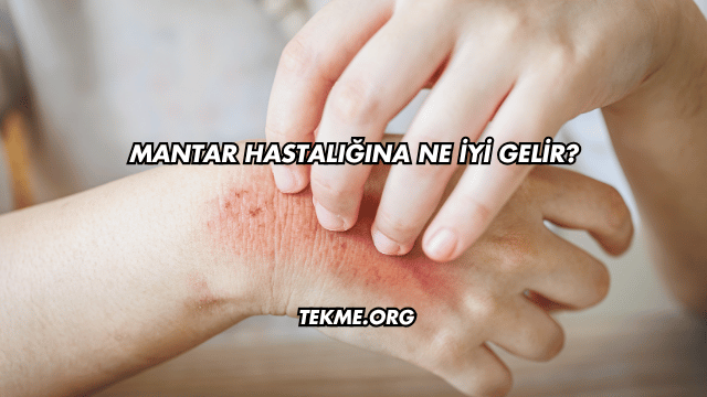 Mantar Hastalığına Ne İyi Gelir?