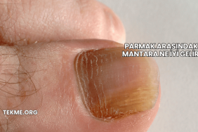 Parmak Arasındaki Mantara Ne İyi Gelir?