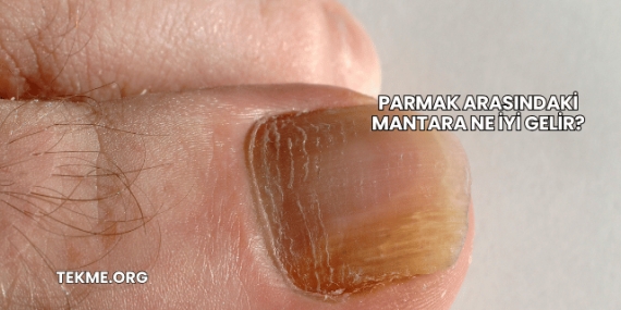 Parmak Arasındaki Mantara Ne İyi Gelir?