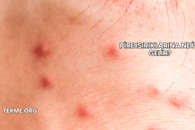 Pire Isırıklarına Ne İyi Gelir?