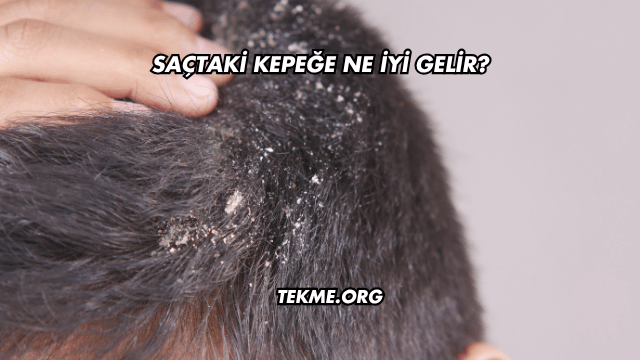 Saçtaki Kepeğe Ne İyi Gelir?