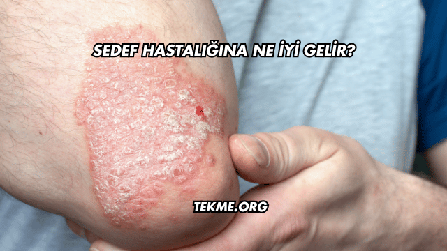 Sedef Hastalığına Ne İyi Gelir?