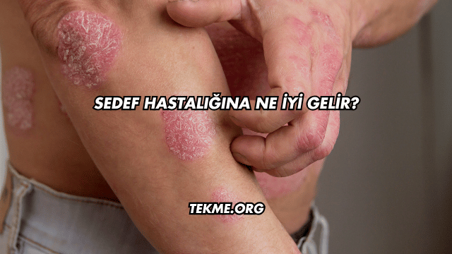 Sedef Hastalığına Ne İyi Gelir?